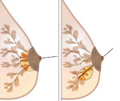 papilom intraductal mamar